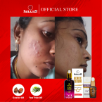Trial Acne set